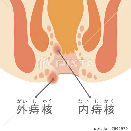 脱肛のイラスト素材