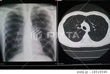 胸部 Ct 検査 肺の写真素材