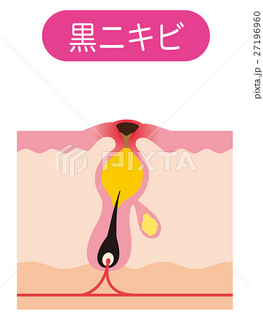 詰まった毛穴のイラスト素材