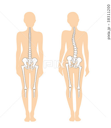 背骨のズレのイラスト素材
