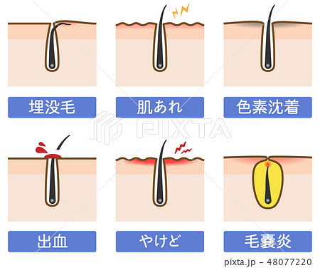 埋没毛のイラスト素材