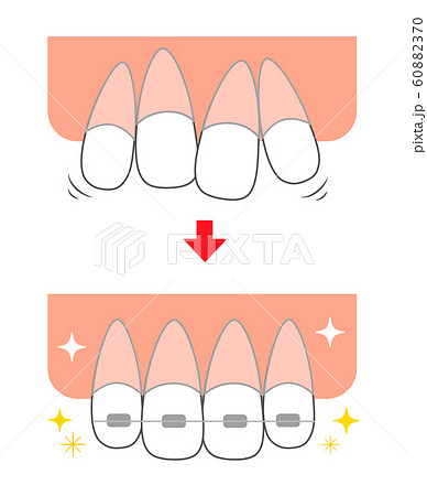 前歯のイラスト素材