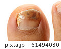 爪水虫 治療 爪 水虫 感染 菌 爪白癬 爪カンジダ症 の写真素材 