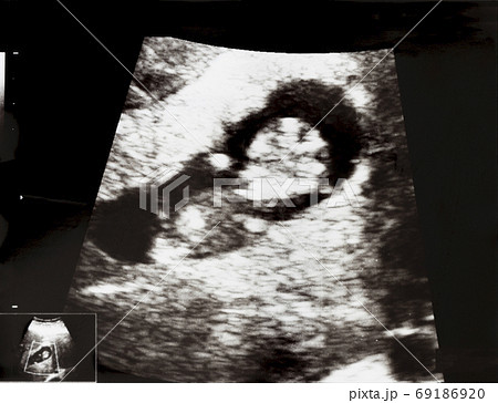 妊娠して9週目の胎児のエコー写真の写真素材