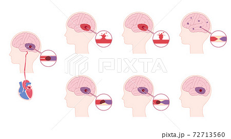 脳血管障害のイラスト素材