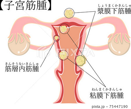 子宮筋腫の写真素材